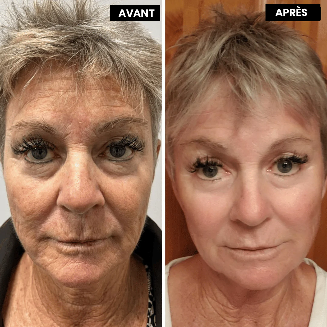 Eyverra™ L’alternative nouvelle génération au rétinol