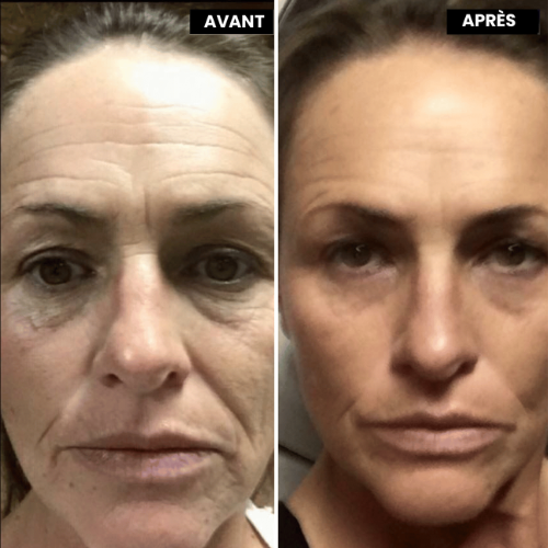 Eyverra™ L’alternative nouvelle génération au rétinol